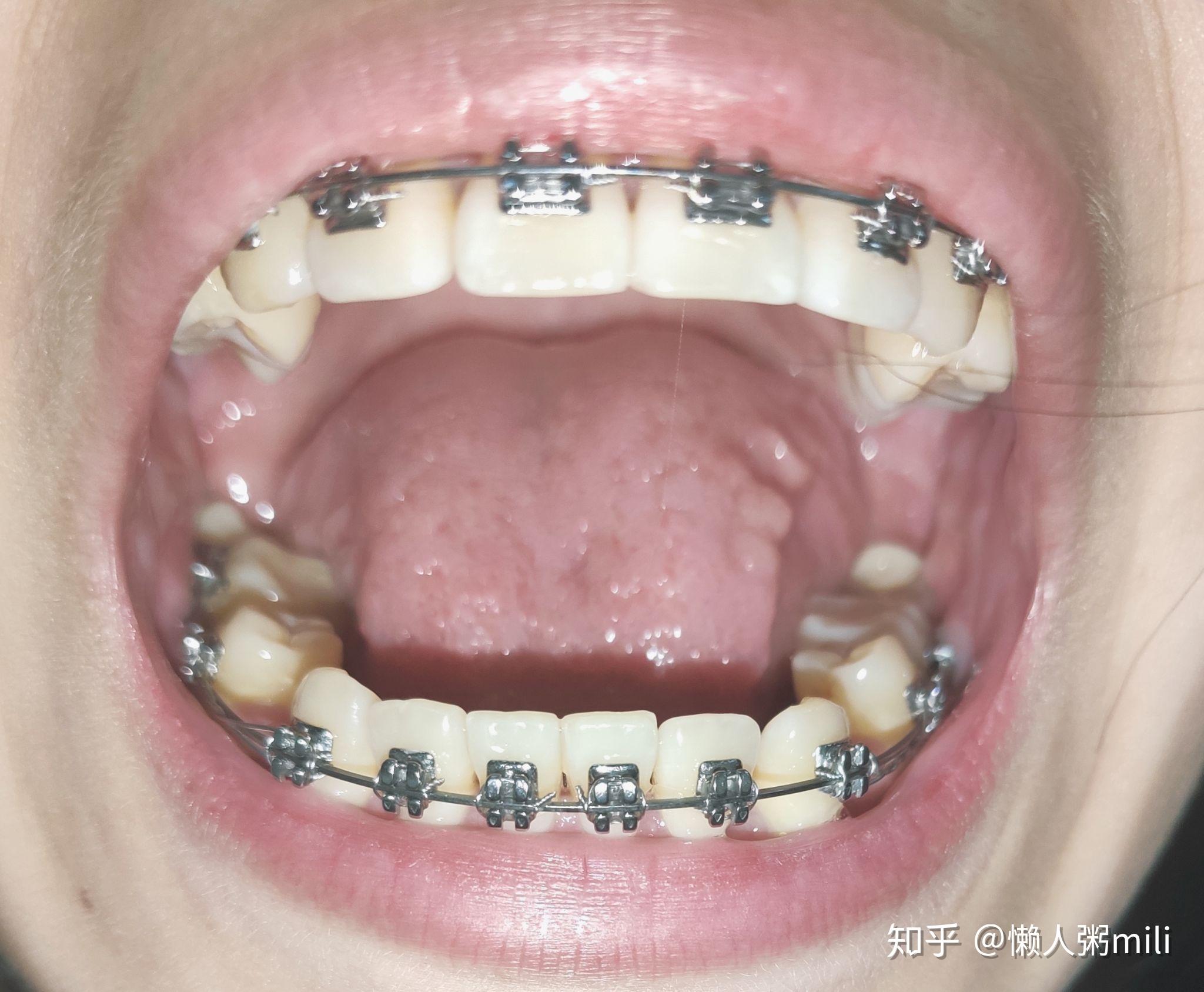 Kaiyun：车祸磕掉一颗牙赔多少钱
