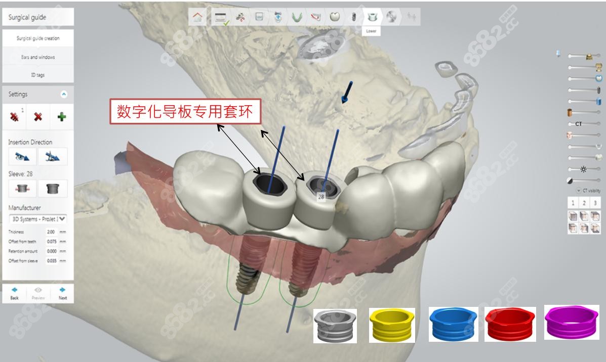爱迪特：3D打印牙冠技术在理论上是可行的且具有广阔的临床应用前景