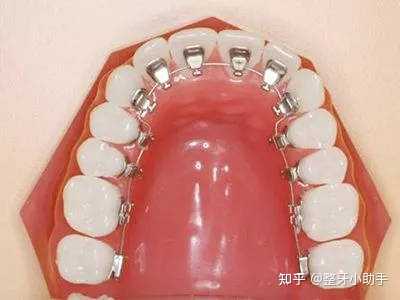 16 岁矫正牙齿算不算晚？